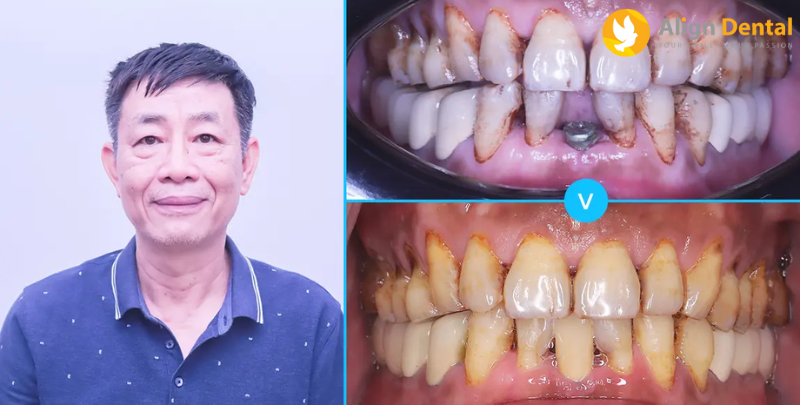 Bệnh nhân Phạm Văn Phú đã trồng răng Implant tại Nha khoa Align Dental