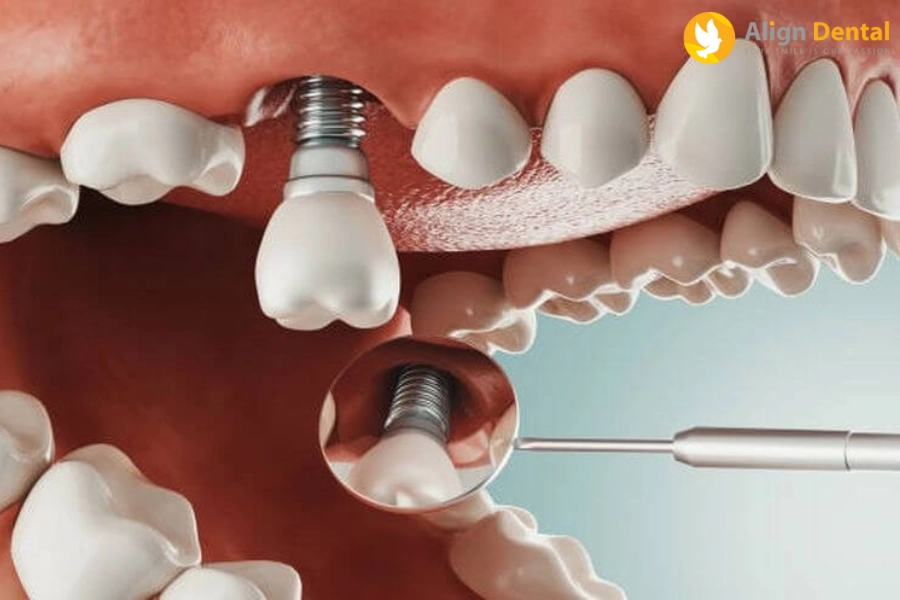 [Chia Sẻ] Kinh Nghiệm Đi Trồng Răng Implant Hiệu Quả - An Toàn