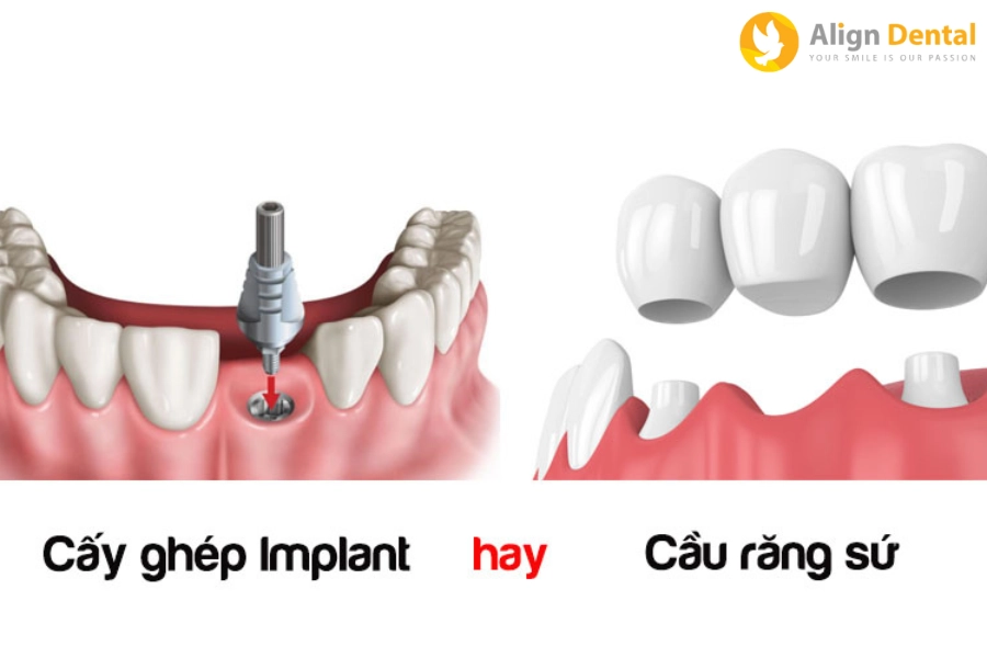 So Sánh Giữa Cầu Răng Và Implant, Nên Chọn Phương Pháp Nào?