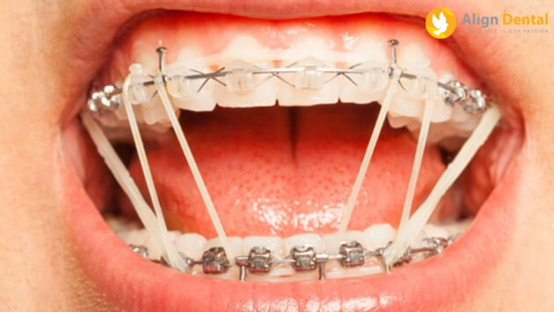 quá trình niềng răng